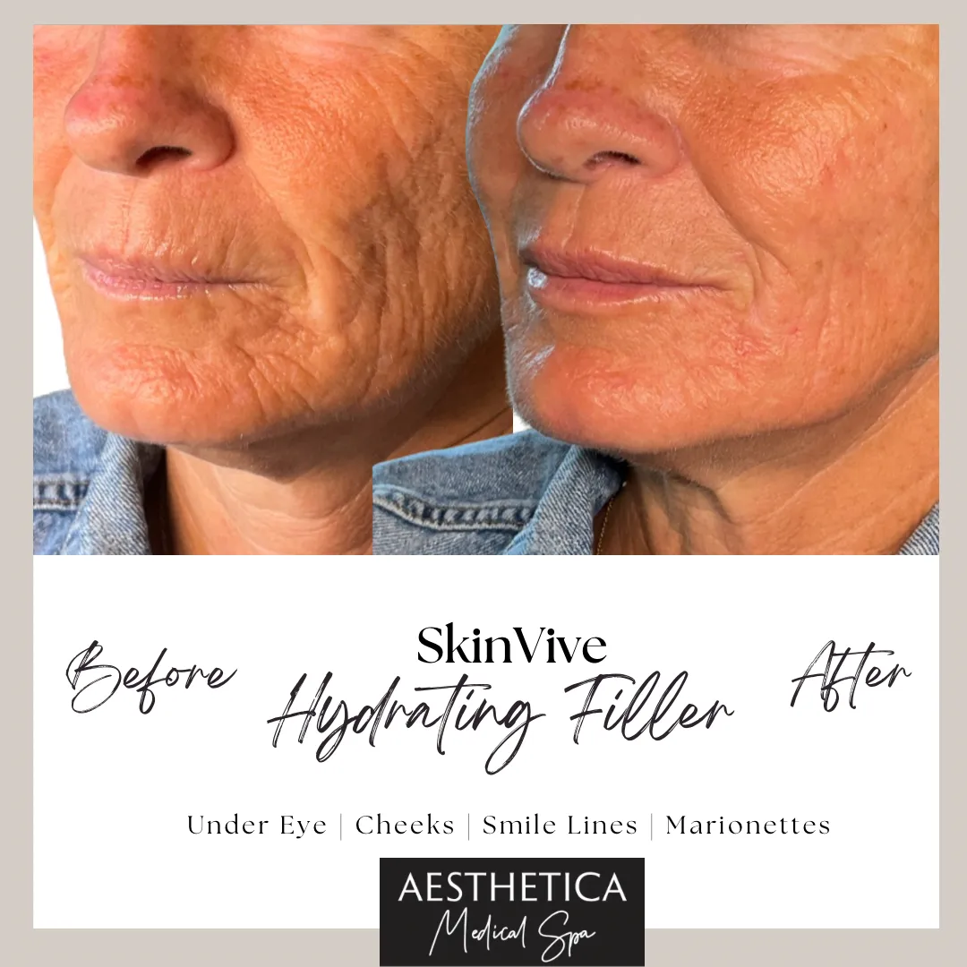 Aesthetica-Medical-Spa-before-and-after-skinvive-a-in-Kalispell-MT