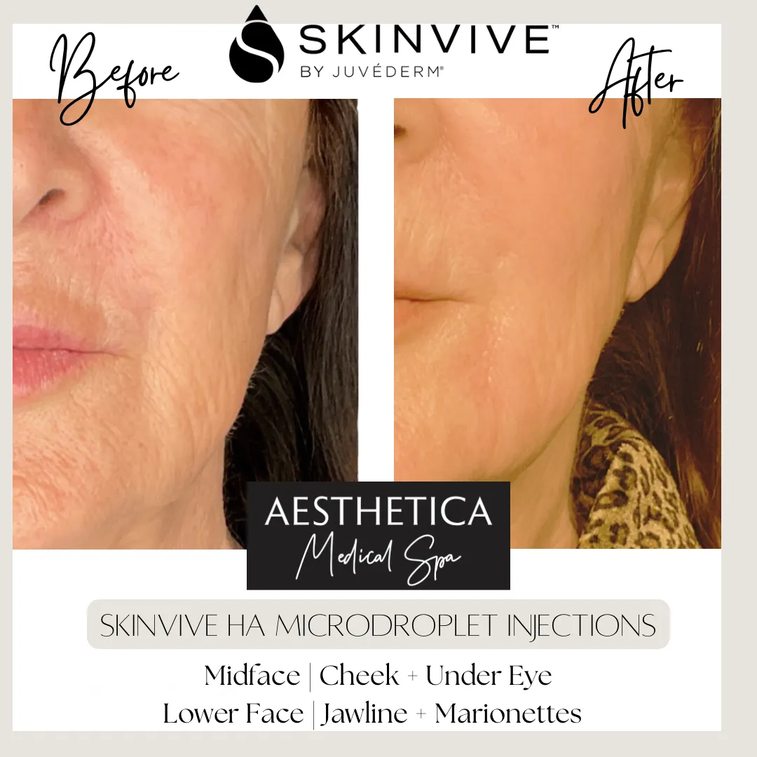 Aesthetica-Medical-Spa-before-and-after-skinvive-b-in-Kalispell-MT