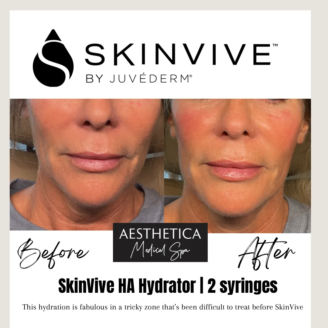 Aesthetica-Medical-Spa-before-and-after-skinvive-d-in-Kalispell-MT