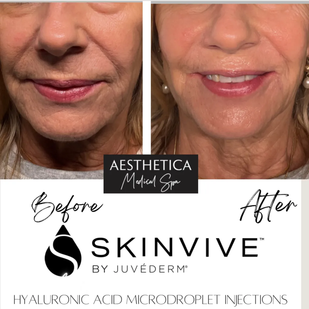 Aesthetica-Medical-Spa-before-and-after-skinvive-e-in-Kalispell-MT