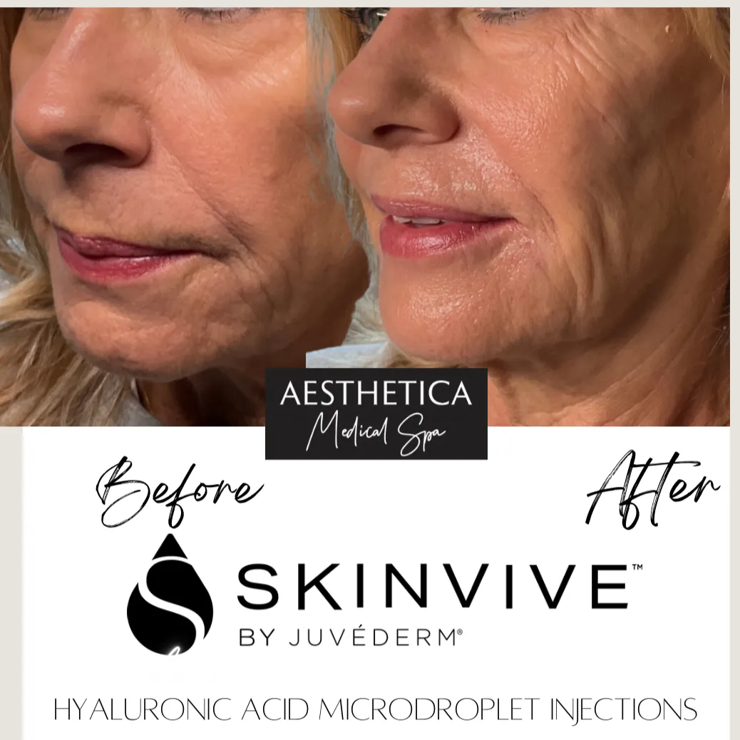 Aesthetica-Medical-Spa-before-and-after-skinvive-f-in-Kalispell-MT