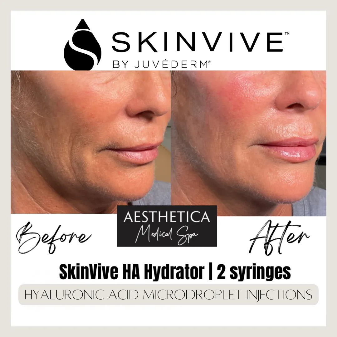 Aesthetica-Medical-Spa-before-and-after-skinvive-g-in-Kalispell-MT