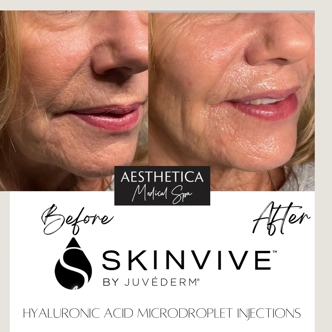 Aesthetica-Medical-Spa-before-and-after-skinvive-h-in-Kalispell-MT