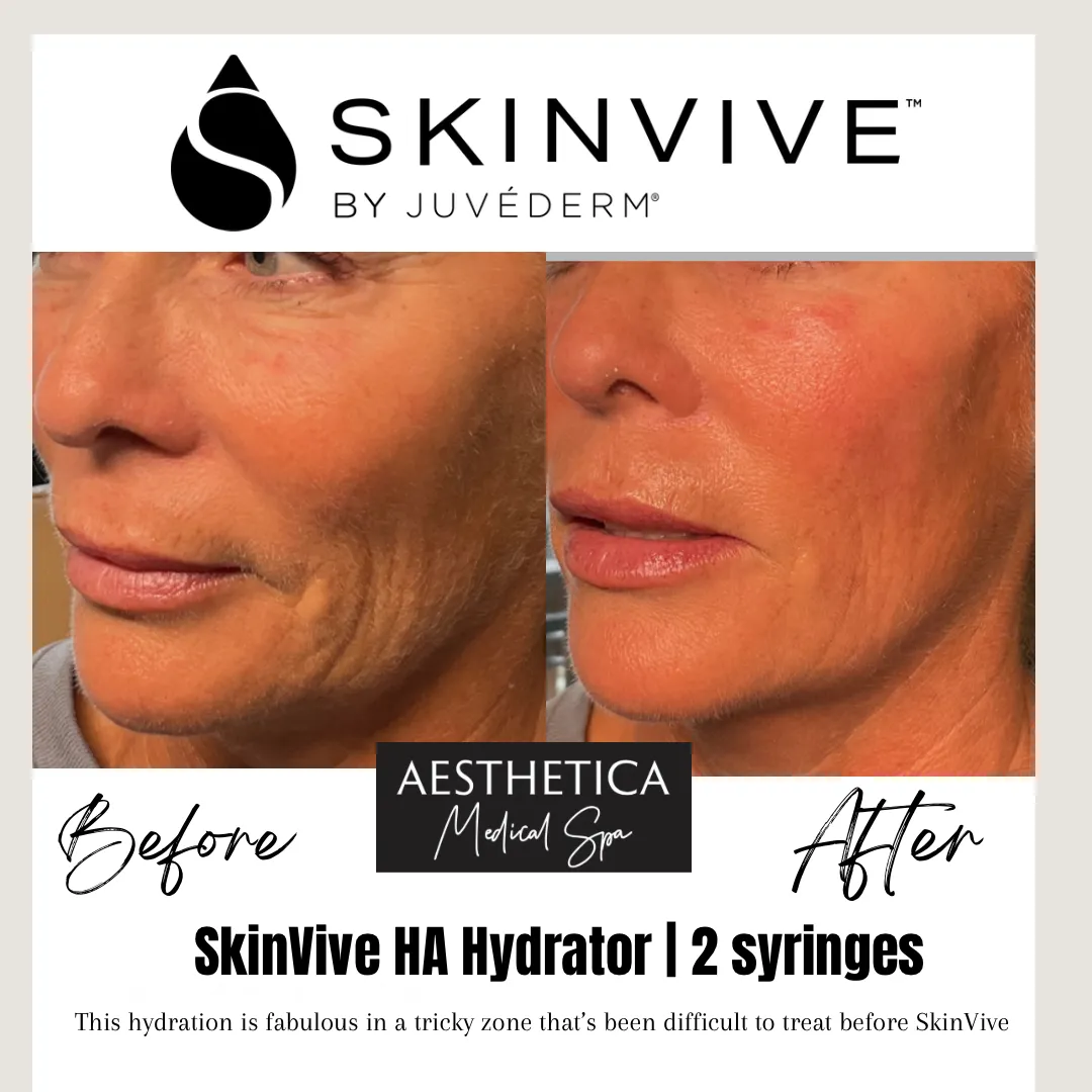 Aesthetica-Medical-Spa-before-and-after-skinvive-j-in-Kalispell-MT