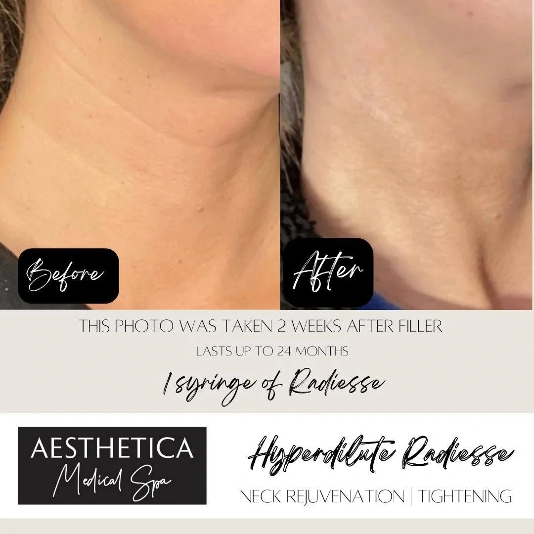 Aesthetica Medical Spa Neck Rejuvenation Before After A in Kalispell, MT