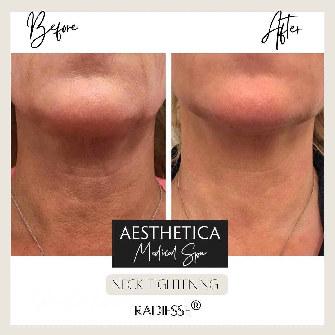 Aesthetica Medical Spa Neck Rejuvenation Before After B in Kalispell, MT