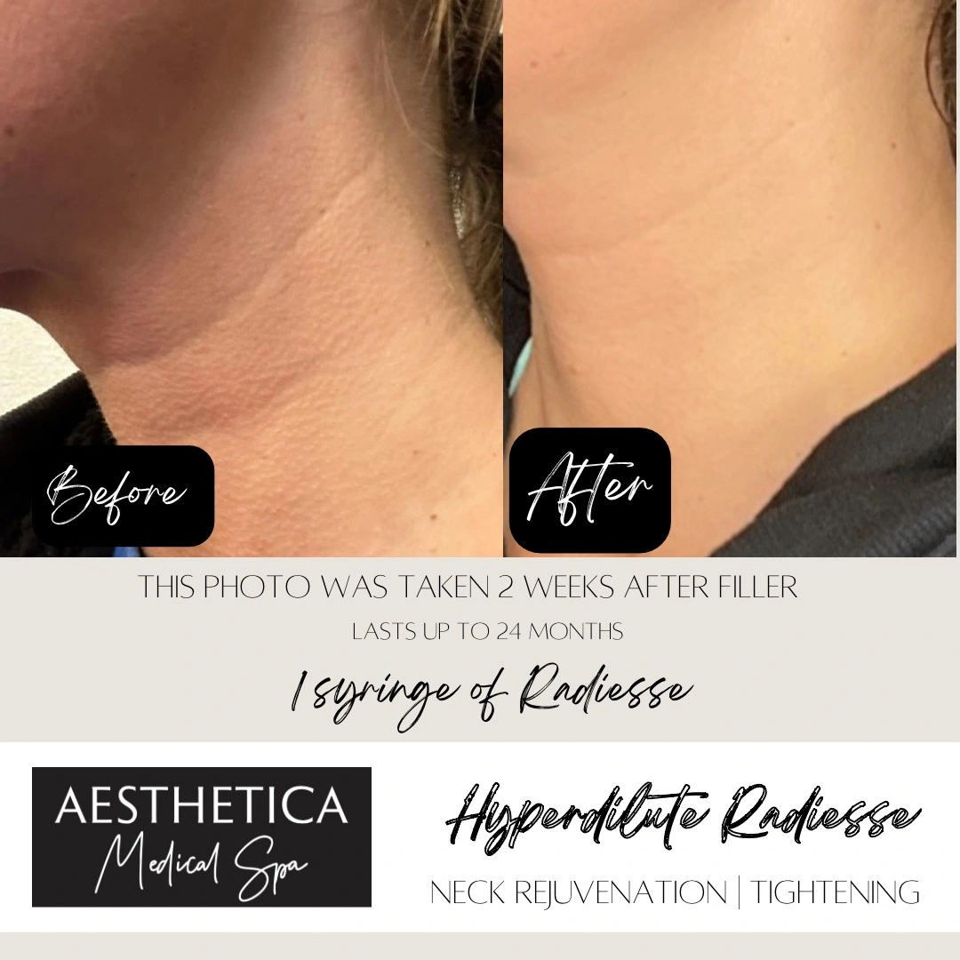 Aesthetica Medical Spa Neck Rejuvenation Before After C in Kalispell, MT
