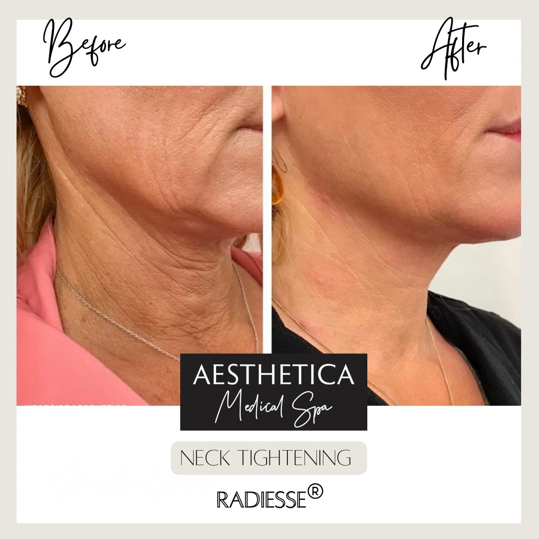 Aesthetica Medical Spa Neck Rejuvenation Before After D in Kalispell, MT