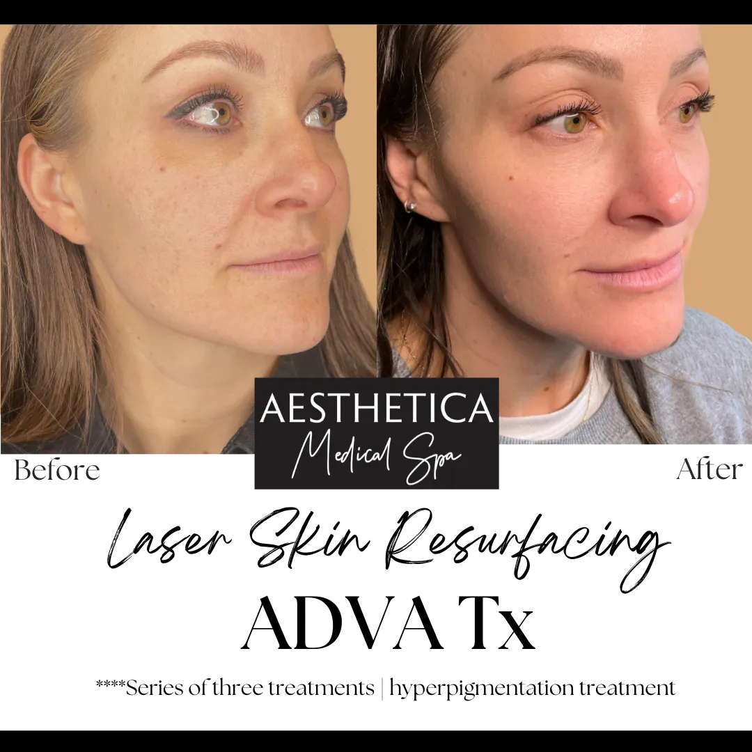 Aesthetica-Medical-Spa-before-and-after-laser-aa-in-Kalispell-MT
