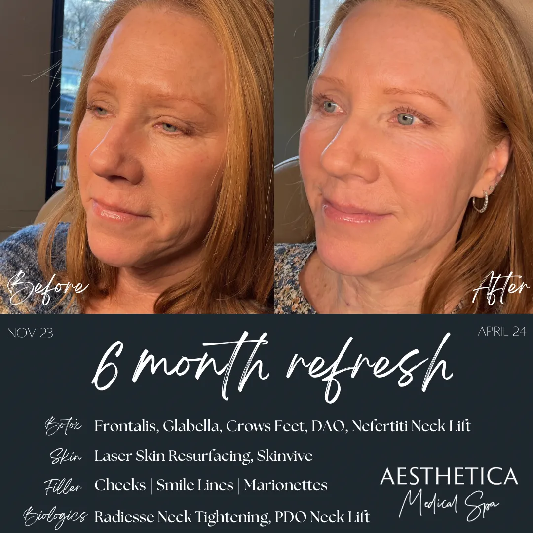 before-and-after-laser-aav-in-Kalispell-MT
