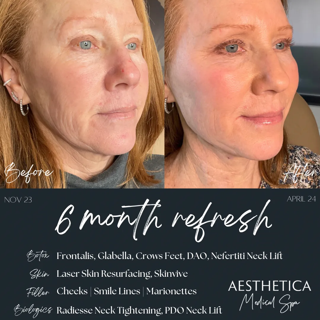before-and-after-laser-av-in-Kalispell-MT