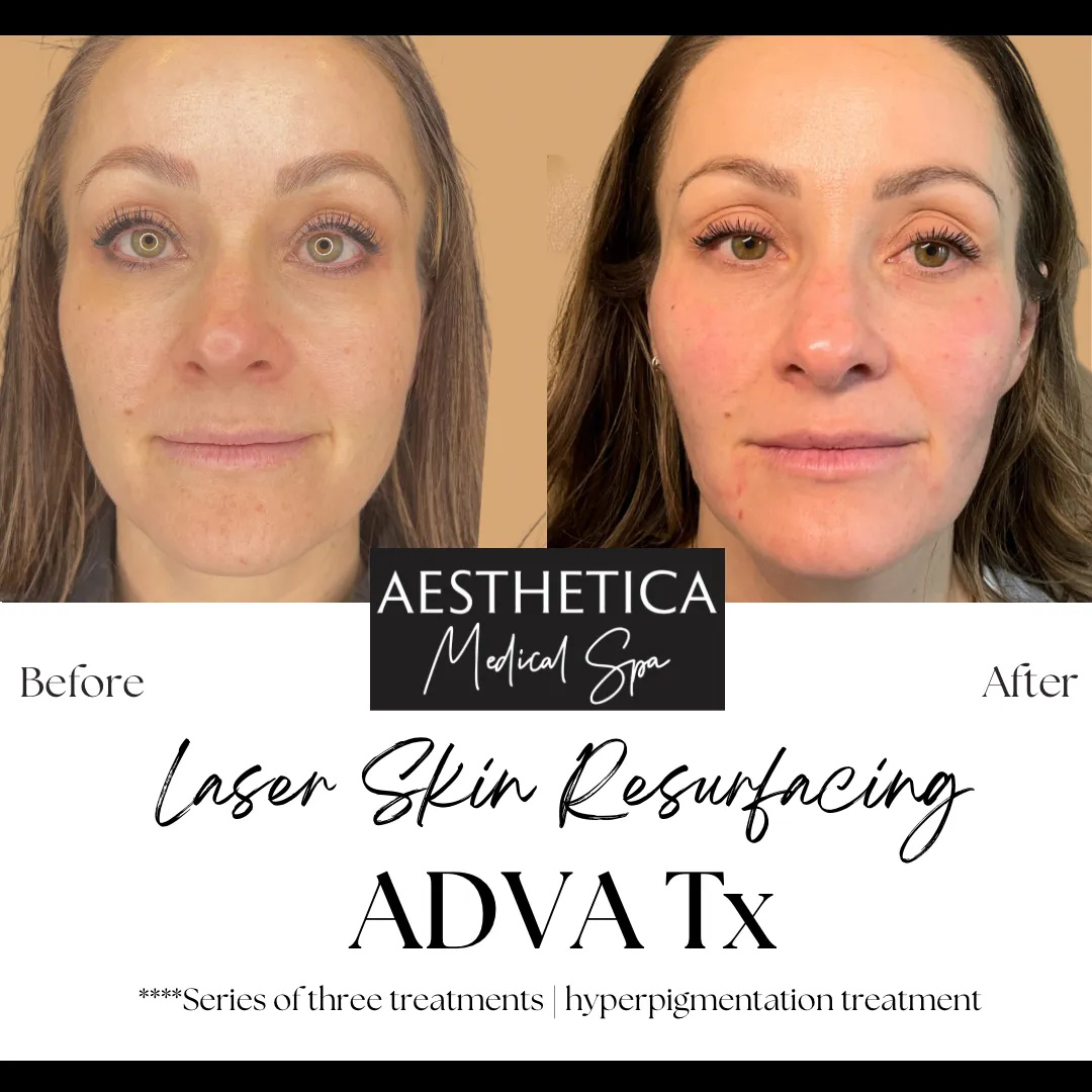 Aesthetica-Medical-Spa-before-and-after-laser-b-in-Kalispell-MT