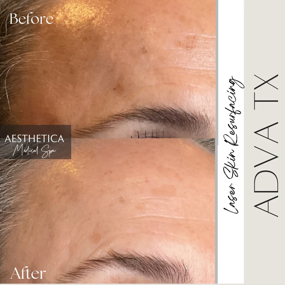 Aesthetica-Medical-Spa-before-and-after-laser-d-in-Kalispell-MT