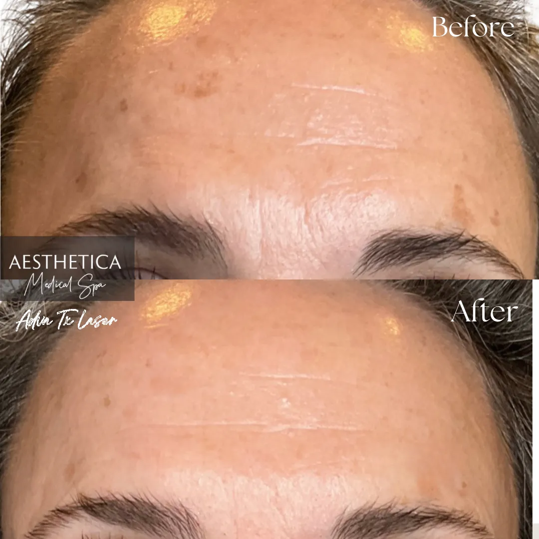 Aesthetica-Medical-Spa-before-and-after-laser-e-in-Kalispell-MT