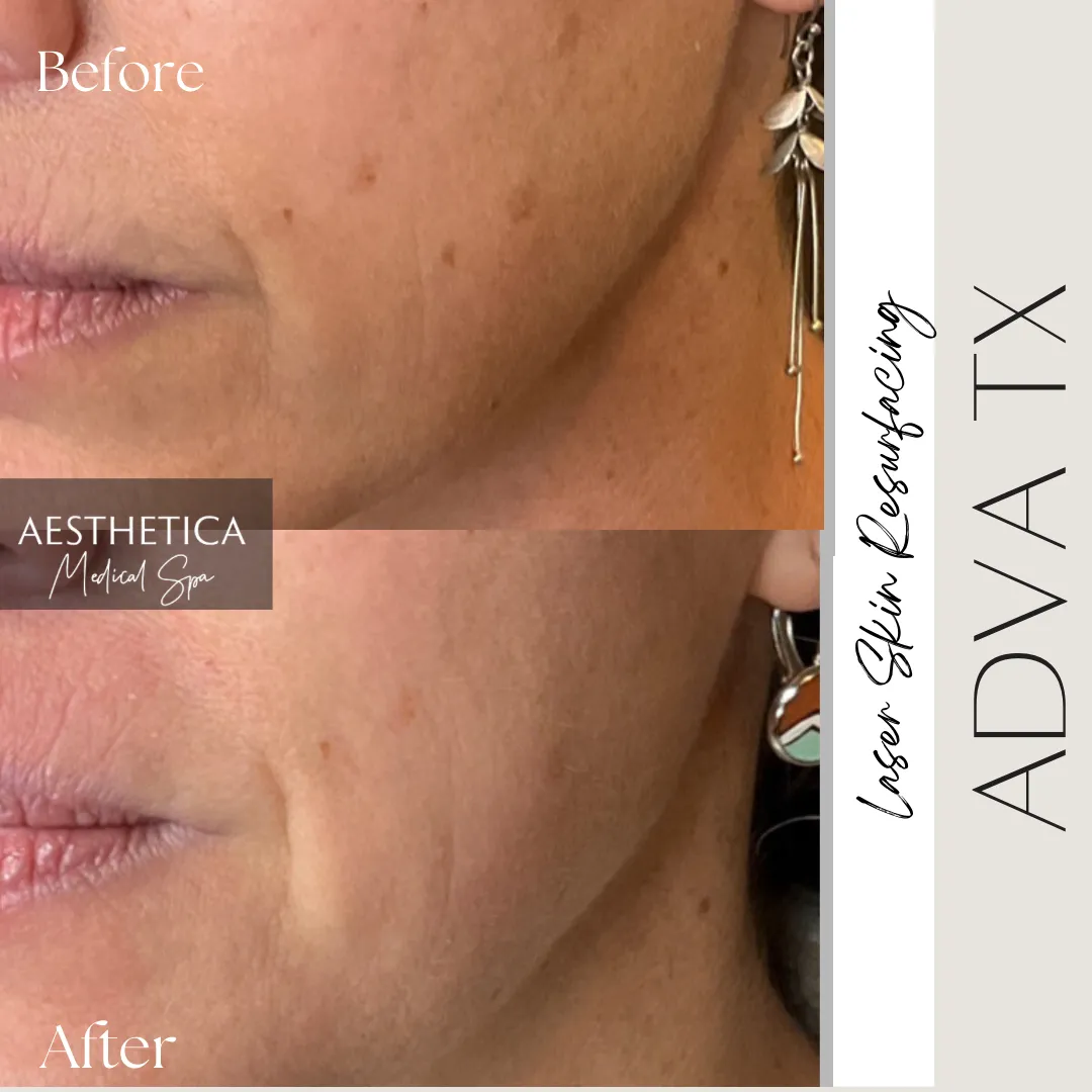 Aesthetica-Medical-Spa-before-and-after-laser-f-in-Kalispell-MT