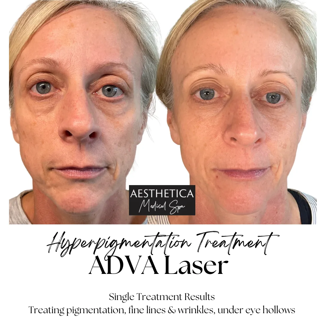 Aesthetica-Medical-Spa-before-and-after-laser-h-in-Kalispell-MT