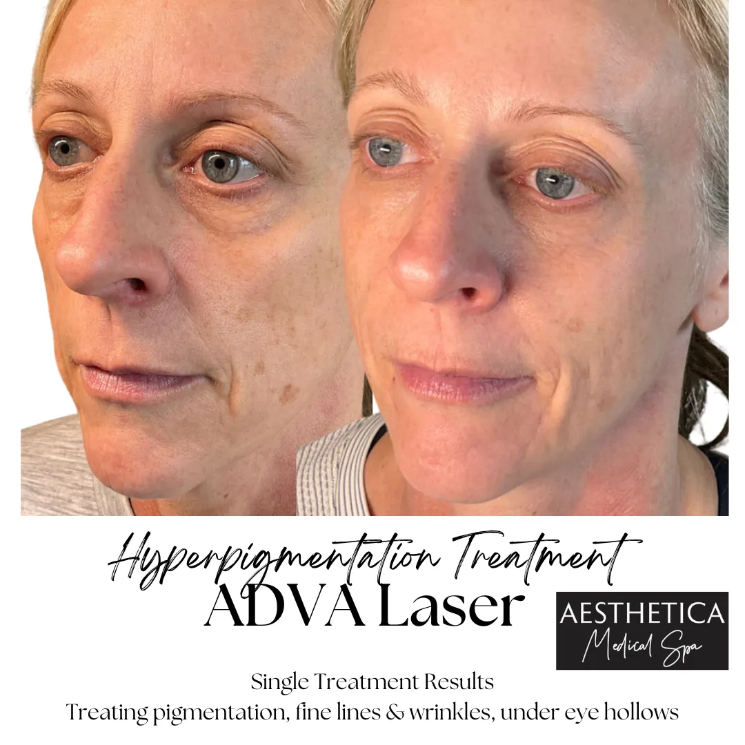 Aesthetica-Medical-Spa-before-and-after-laser-i-in-Kalispell-MT