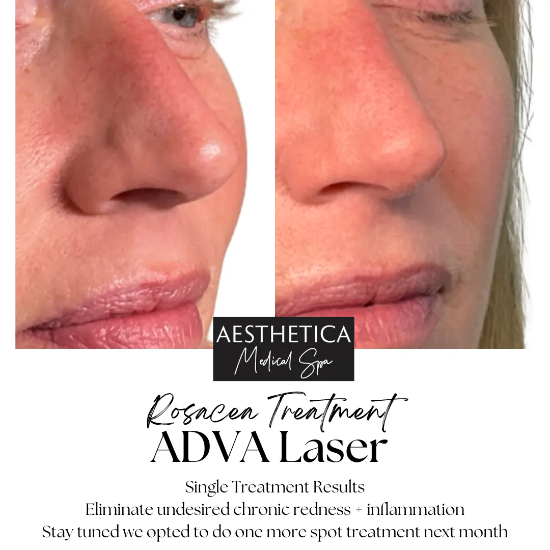 Aesthetica-Medical-Spa-before-and-after-laser-j-in-Kalispell-MT
