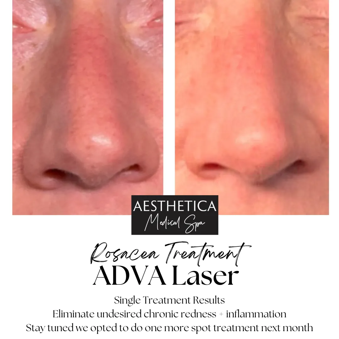 Aesthetica-Medical-Spa-before-and-after-laser-l-in-Kalispell-MT