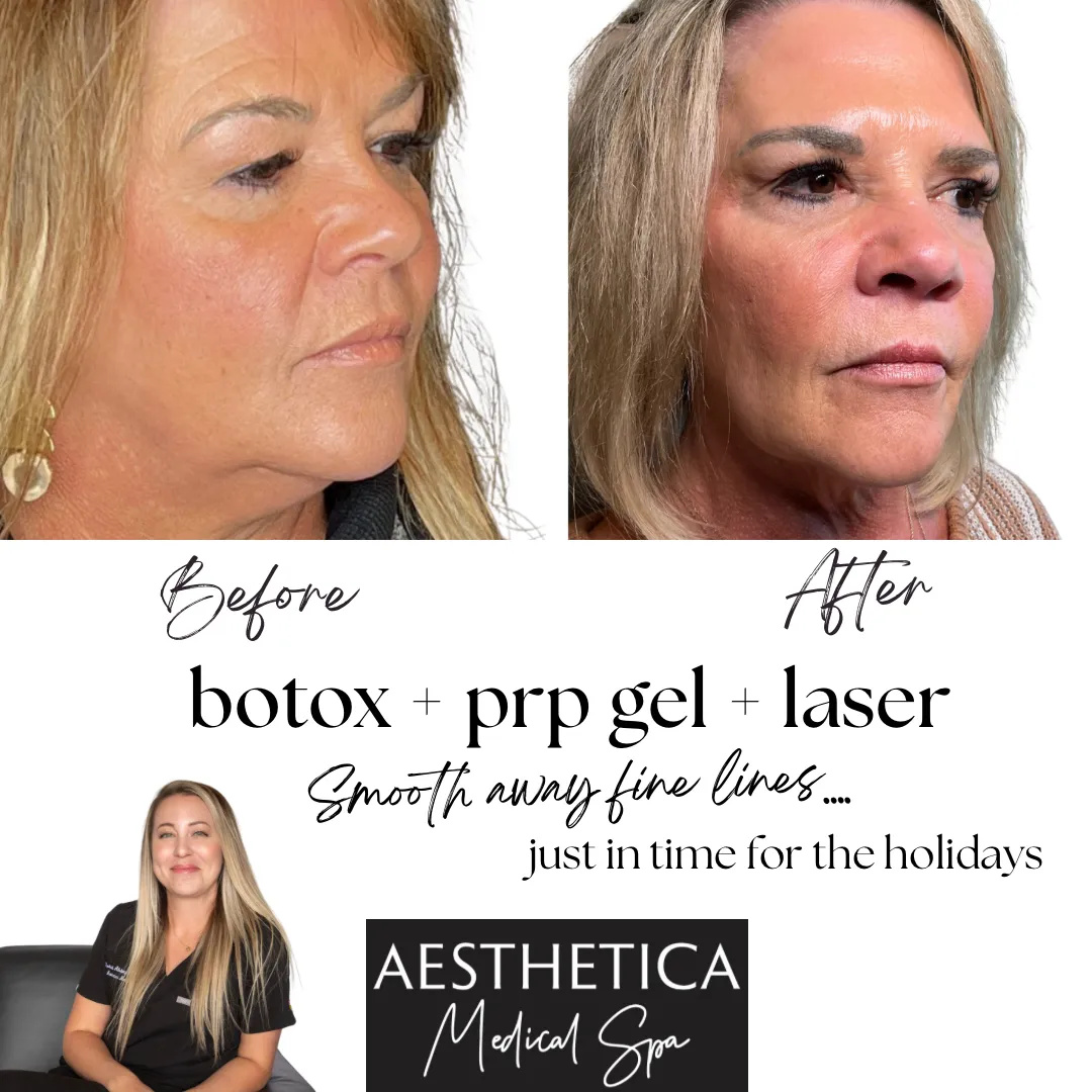 Aesthetica-Medical-Spa-before-and-after-laser-m-in-Kalispell-MT