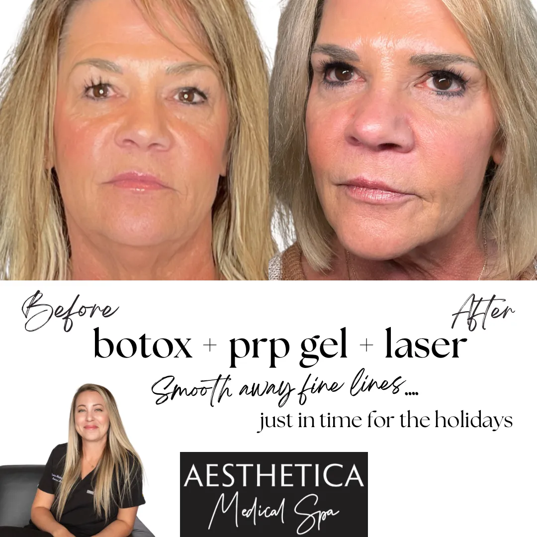 Aesthetica-Medical-Spa-before-and-after-laser-n-in-Kalispell-MT