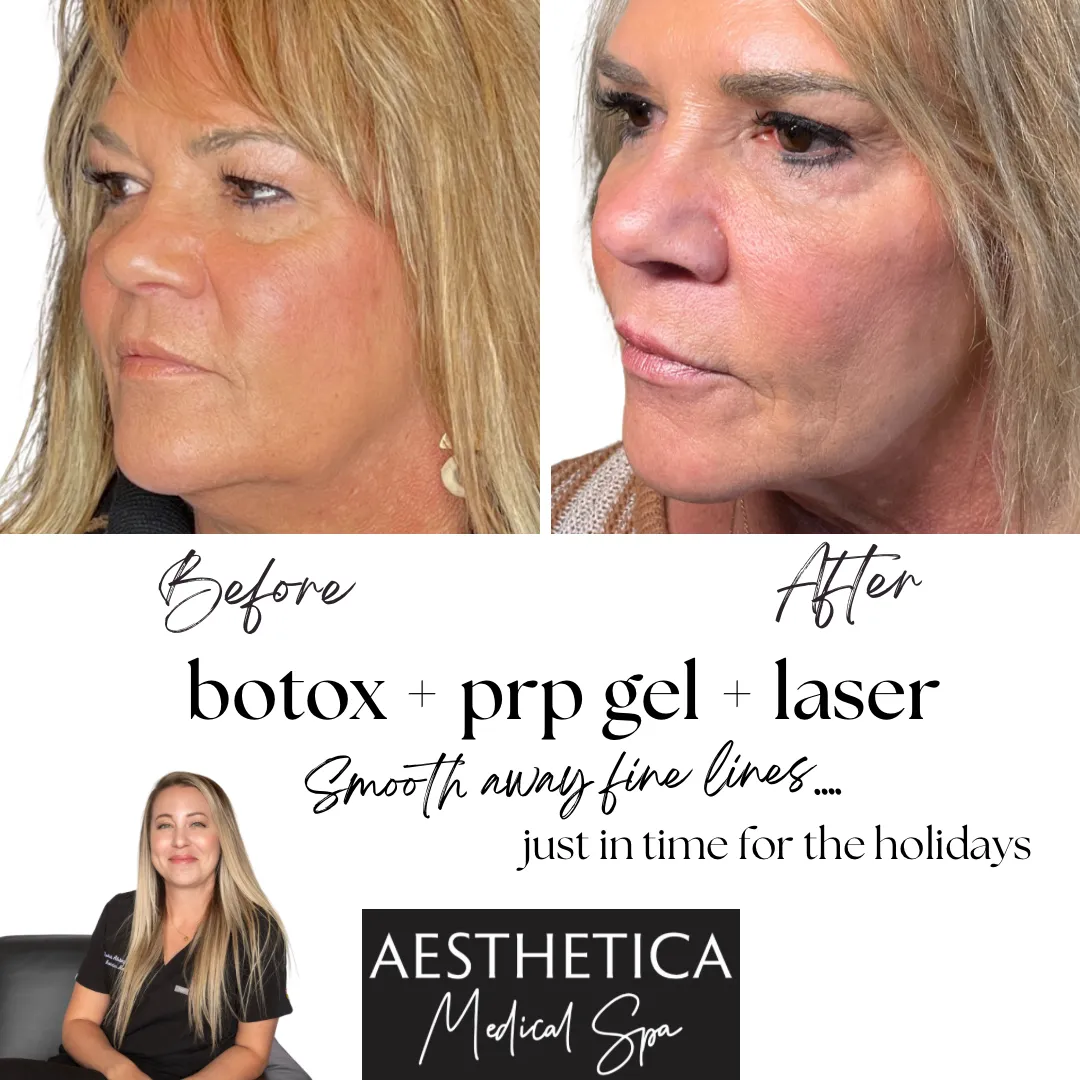 Aesthetica-Medical-Spa-before-and-after-laser-o-in-Kalispell-MT