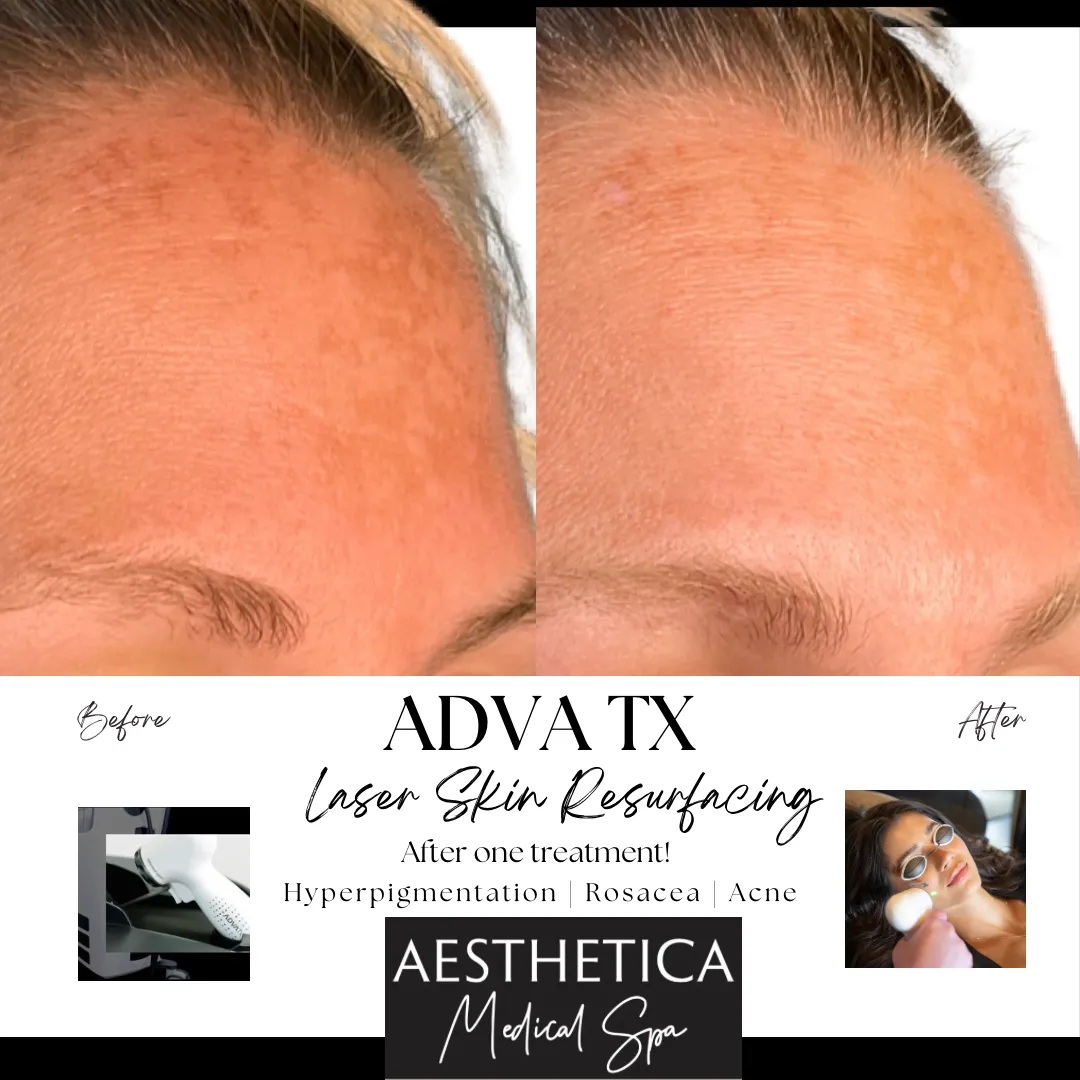 ADVATX Laser Skin Resurfacing