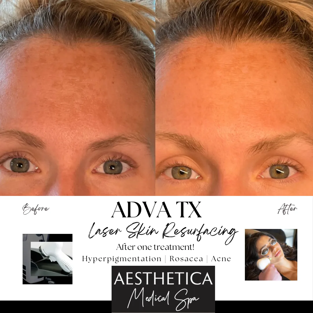 ADVATX Laser Skin Resurfacing