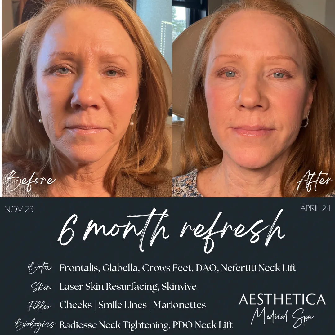 before-and-after-laser-t-in-Kalispell-MT